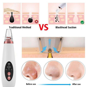 Pore and blackhead remover