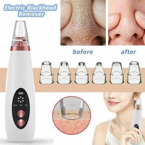 Pore and blackhead remover